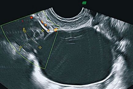 Formarea tumorii a apendicelor uterine