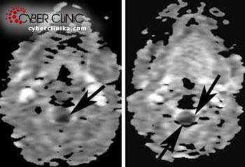 Tumora de creier - tratamentul cancerului cerebral în Rusia - clinica cibernetică spizhenko