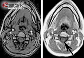 Tumora de creier - tratamentul cancerului cerebral în Rusia - clinica cibernetică spizhenko