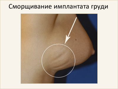 Utáni szövődmények mammoplasty helyi és általános alaplistáját és ellenőrző intézkedések