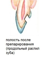 Основні принципи лікування карієсу при каріозних порожнинах i класу по Блеку