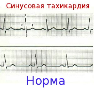 Основні ознаки та симптоми тахікардії методи діагностики і лікування