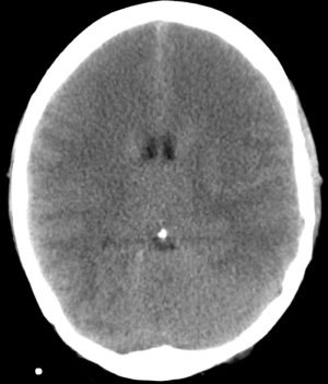 Simptomele edemului cerebral, cauzele, efectele și tratamentul, semne de edem la nou-născuți