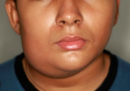 Umflarea feței, simptome și metode de eliminare