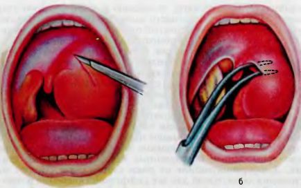 Паратонзіллярний абсцес його прочаленія і лікування