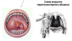 Peritonsillaris tályog otthoni kezelés