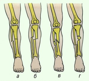 Fractura tibiei