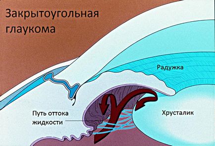 Glaucomul principal de închidere a unghiului - cauze, simptome, tratament și prevenire