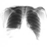 Пневмонія (запалення легенів)