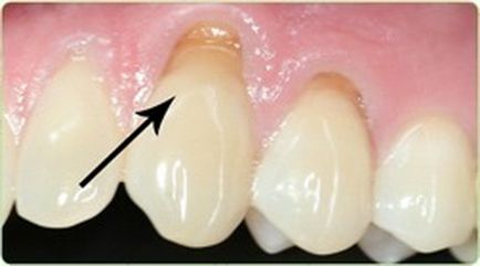 Чому зуби не відновлюються
