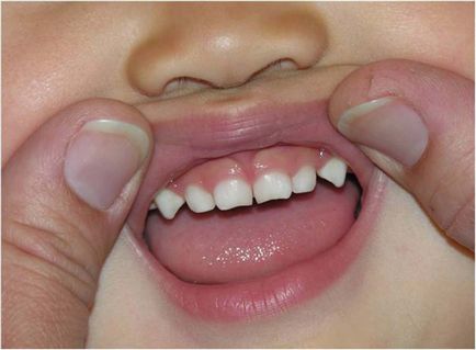 Cauze de dentiție tardivă la copii