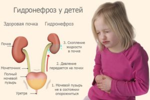 Принципи лікування гідронефрозу - у дітей, у вагітних, без операції, народними засобами, період