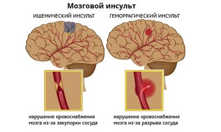 Ознаки та симптоми ішемічного і геморагічного інсульту