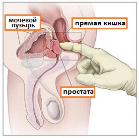 Prostatita - informații despre simptome