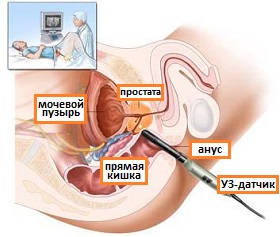 Простатит - симптом інфо