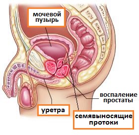 Простатит - симптом інфо