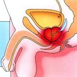 Prostatita - informații despre simptome