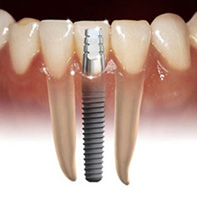 fogpótlások - Dental-Kheikhe - fogászati ​​kezelés Kheikhe, kína