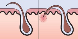 Псевдофоллікуліт - ефективне лікування