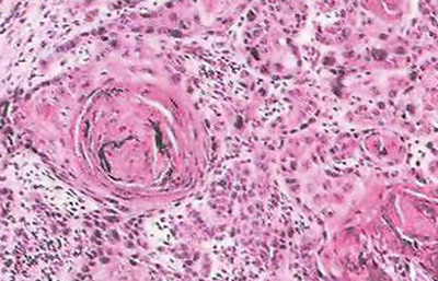 Cancerul simptomelor glandelor salivare și tratamentul oncocitomilor, un prognostic pentru viață