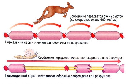 sclerosis multiplex