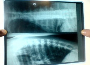 Cauze și simptome ale osteocondrozei