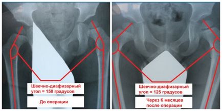 X-ray a articulațiilor șoldului la copii normă, transcriere, patologie