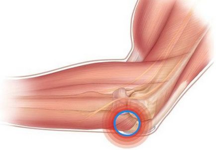 Diagnosticarea și tratarea articulației bilioase seroase bilios și tratamentul bolii