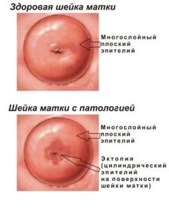 Cervixul uterului