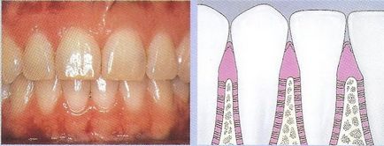Tünetei a periodontális betegség (a tünetek) a periodontitis tünetei
