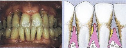 a periodontitis tünetei