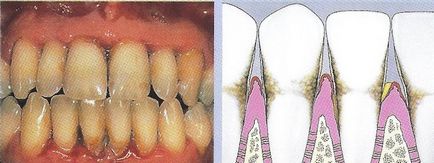 a periodontitis tünetei
