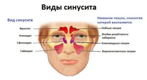 Синусит у дітей симптоми і лікування дитини в домашніх умовах