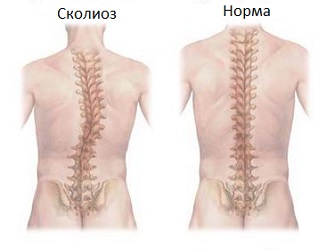 Scolioza 1, 2, 3 grade fotografii, simptome și tratament