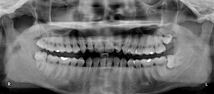 Câte canale în dintele maxilarului superior și inferior