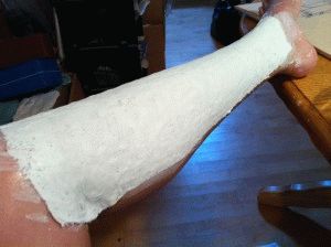 Mennyit kell járni gipszkötéssel törött sípcsont kifejezések, funkciók, tippek (sípcsont) Mennyit kell járni gipszkötéssel törött sípcsont kifejezések, funkciók, tippek
