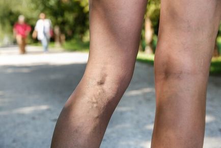 Vaselina vasculara pe picioare cum se vindeca vene varicoase