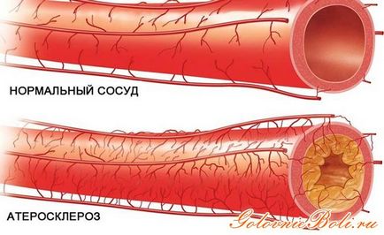 Судинний склероз причини прояви і профілактика