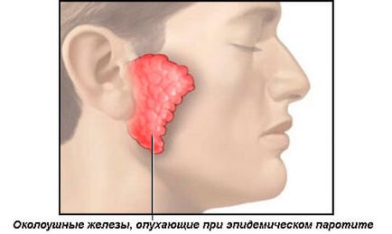 Simptome de porc la adulți, tratament la domiciliu, antibiotice pentru oreion