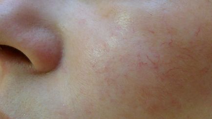 Троксерутин від купероза на обличчі відгуки та рекомендації до застосування