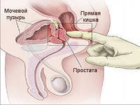 Prostatita tuberculoasă - informații generale, simptome și diagnostice, tratament