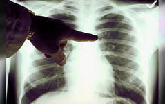 Туберкульозний простатит - загальні відомості, симптоми і діагностика, лікування