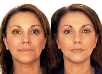 Lifting facial lichid | Lifting facial nechirurgical | SKiN MedSpa