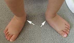 Valgus deformare a piciorului la copii - tratamentul piciorului valgus