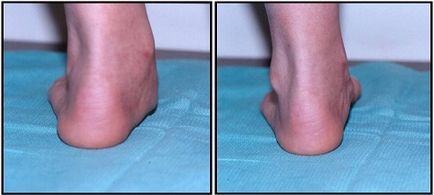 Valgus deformare a piciorului la copii - tratamentul piciorului valgus