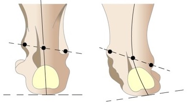 Valgus deformare a piciorului la copii - tratamentul piciorului valgus