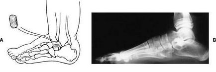 Valgus deformare a piciorului la copii - tratamentul piciorului valgus