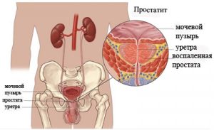 Виділення при простатиті у чоловіків опис, фото, чи бувають