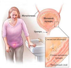 Pierderea mucoasei uretrale la femei, tratament, simptome