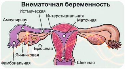 Ectopic semne sarcinii în perioadele timpurii, fotografie